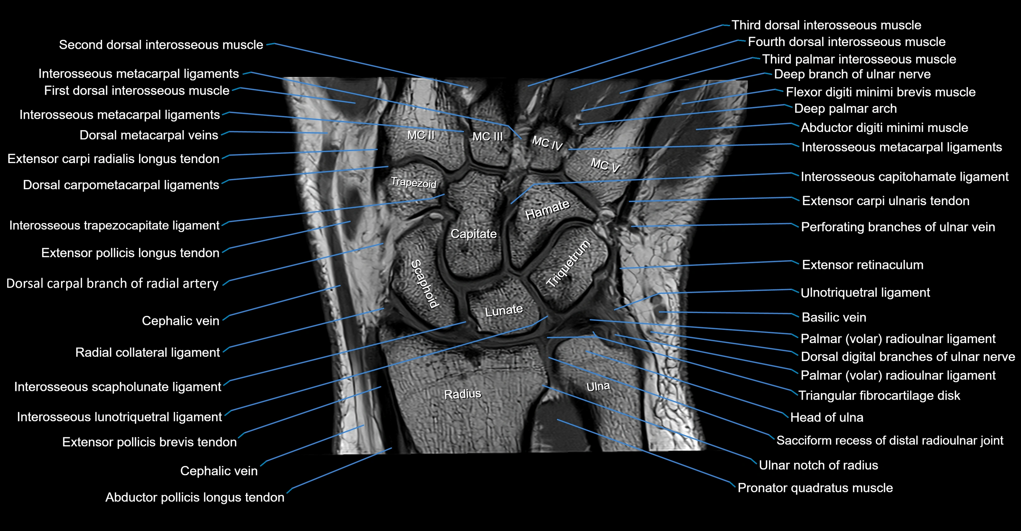 MRI wrist coronal cross sectional anatomy 3T  radiology  image-img-00001-00013.webp